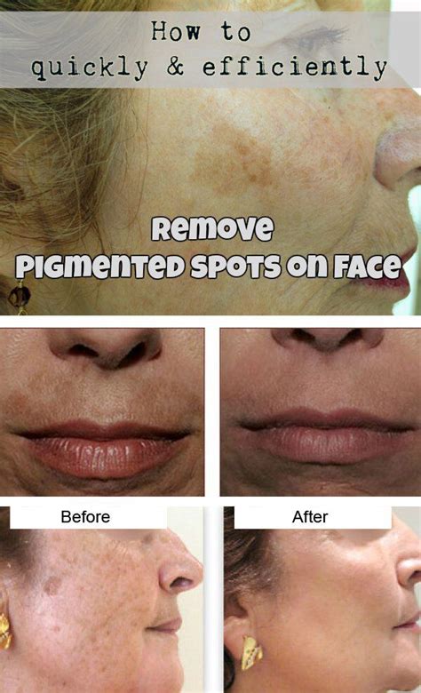 Pigmented Spots On The Face Cause Undoubtedly Many Troubles To