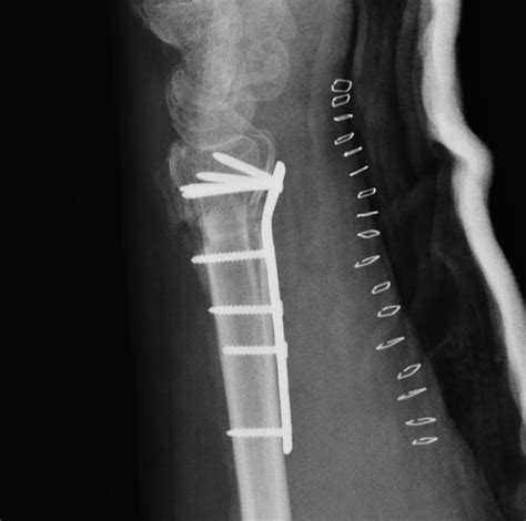 Distal Radius Malunion The Bone School