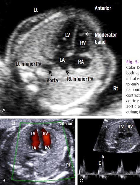 Figure 5 From Technique Of Fetal Echocardiography Semantic Scholar