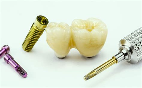 Dental Implants All Questions Answered