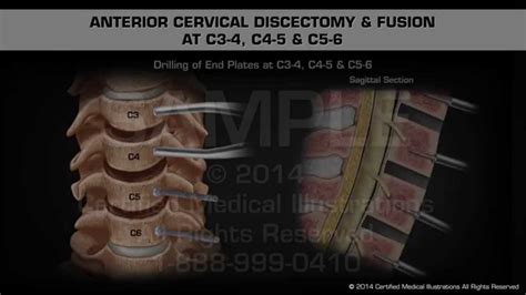 Anterior Cervical Discectomy And Fusion At C3 4 C4 5 And C5 6 Youtube