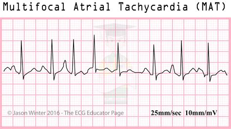 Mat Multifocal Atrial Tachycardia Clinical Cardiology Grepmed