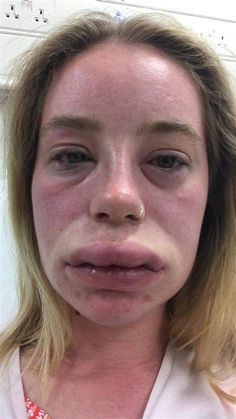 Arneridesign Allergies Swollen Lips Hives