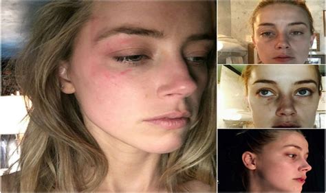 Amber Heard Releases New Photos Of Alleged Domestic Abuse By Johnny Depp Entertainment News