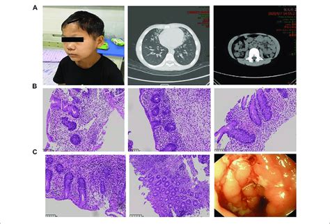 Manifestations Caused By Autoimmune Disorders In Different Organ