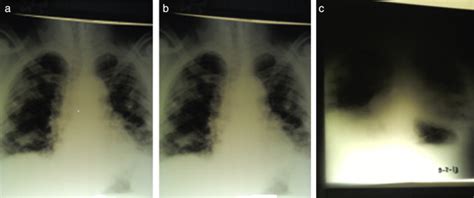 Serial Chest Radiographs From February 3rd At A 1200 Pm B 500