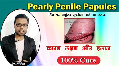 Pearly Penile Papules लिंग पर सर्कुलर दाने का इलाज Ppp Treatment