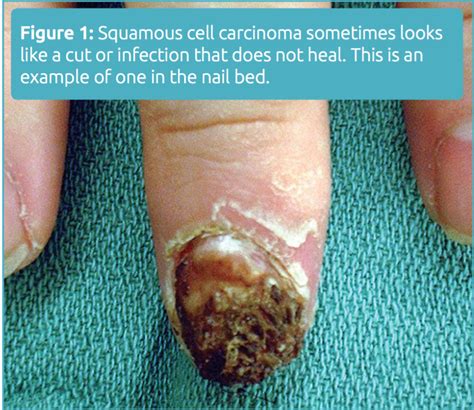 Excision Of Skin Cancer Non Melanomatous Of The Handfinger 11 20