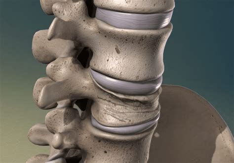 Spinal Arthritis What Does Spinal Arthritis Look Like