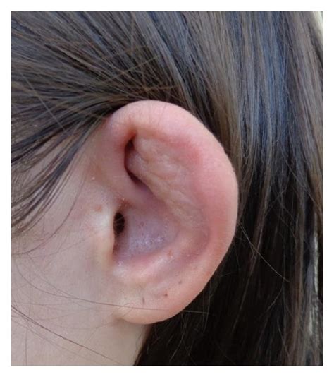 A B Cauliflower Ears Swelling And Erythema Of The Cartilaginous