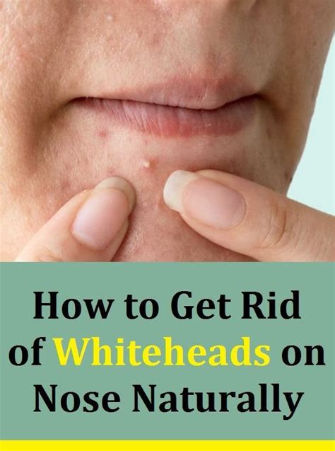 How To Get Rid Of Whiteheads On Nose Naturally Natural Face Pack