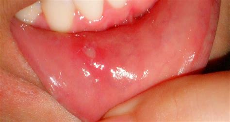 Aphtous Ulcer And Herpes Mouth Wounds Dentince