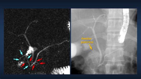 Tracing The Intriguing Duct Of Annular Pancreas By Ct And Mri Youtube