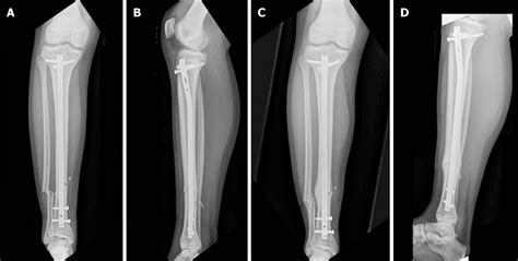 Rigid Locked Nail Fixation For Pediatric Tibia Fractures Where Are