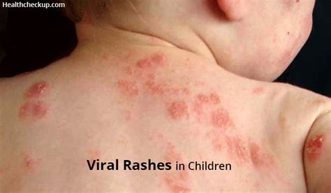 Skin Rashes In Kids Firmtech