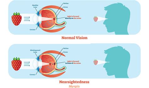 Myopia Nearsighted Chicago Eye Doctor