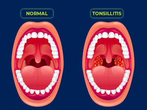 Tonsillitis And Oral Health Ezza Dental Care