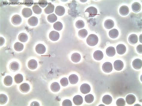 Lvlupfit.comwhat organ in just underbthe bottom left rib : Morgellons Disease Awareness - Live blood microscopy in a person suffering from Morgellons ...