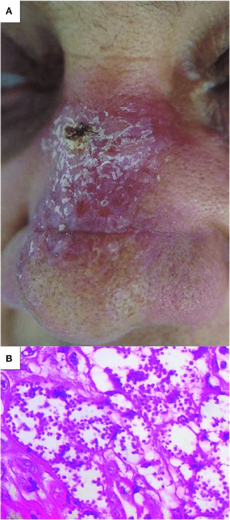 Clinical Presentation A Erythematous Plaque On The Nose And B