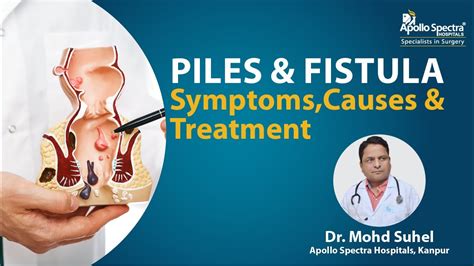 Piles Fistula Symptoms Causes Treatment YouTube