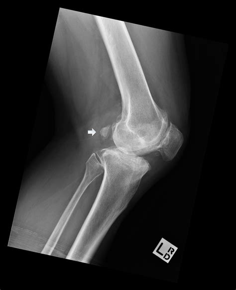 Adult Knee Radiographic Views Trauma Orthobullets