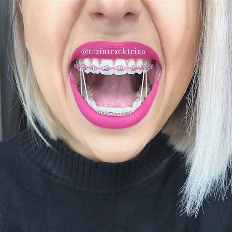 pin by elizabeth mack on teeth cute braces brace face cute braces colors