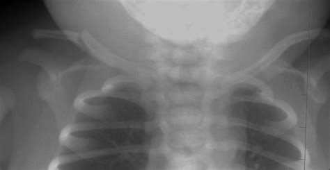 Clavicle Bone Fractures