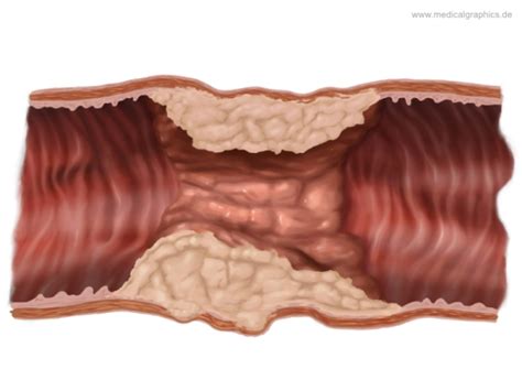 This part of the colon normally lies within the pelvis, but due to its freedom of movement it is liable to be displ. Infiltrating adenocarcinoma - colon sigmoideum ...
