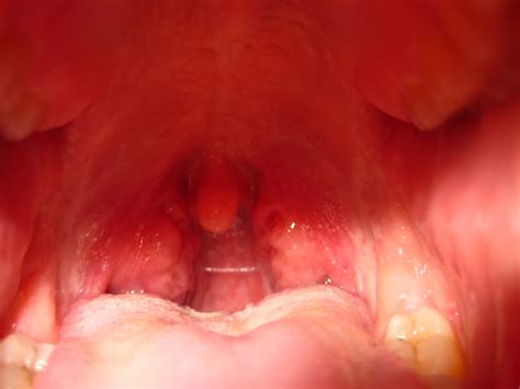 Swollen Tonsil On One Side Causes And Treatments New Health Advisor