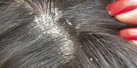 4 Different Types Of Dandruff And How To Tackle Them Effectively