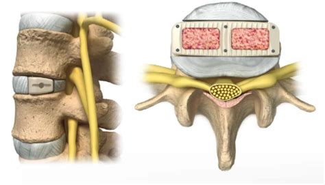 Lumbar Spine Minimally Invasive Lateral Interbody Fusion Precision