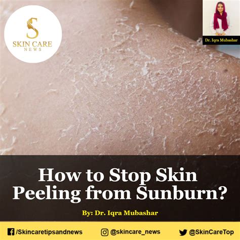 How To Stop Skin Peeling From Sunburn Skincaretopnews