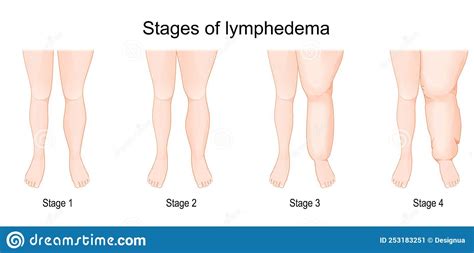 Lymphedema Stages Lymphatic System Dysfunction Disease Swollen Legs
