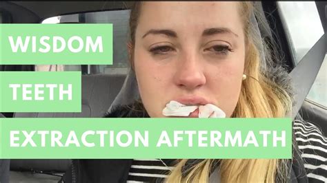 Wisdom Teeth Removal Aftermath Embarrassingly Funny Reactions Youtube