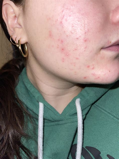 Skin Concerns I Cant Get Rid Of My Clogged Pores And Redness Any