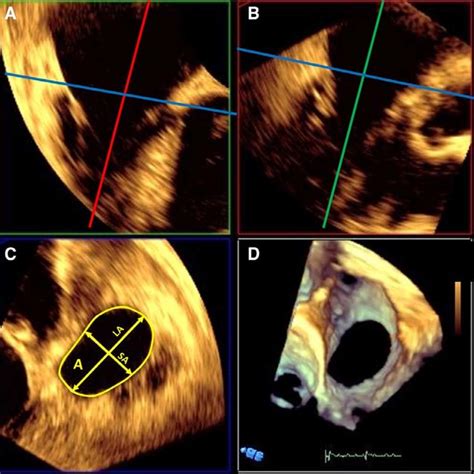 Tricuspid Annulus Shape And Orientation Distribution A Of The