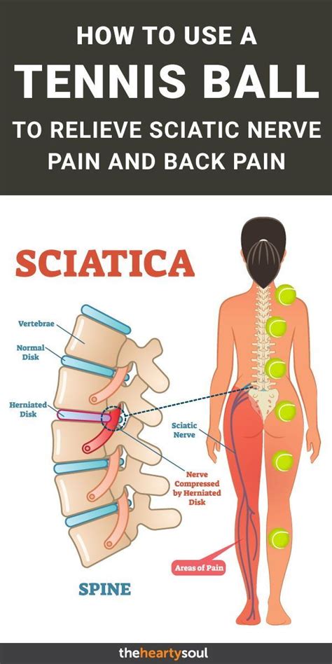 The nervus ischiadicus, or sciatic nerve, causes a great deal of. Pin on Back pain