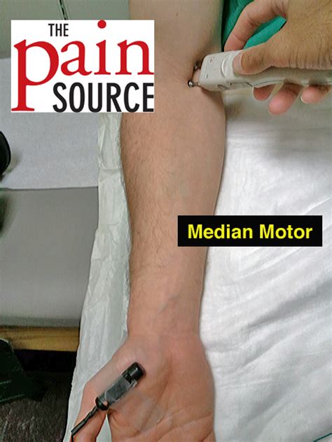 Setup Median Motor Ncs The Pain Source Makes Learning About Pain