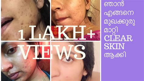 My Acne Story How To Get Clear Skin മുഖക്കുരു മാറ്റാൻ ഞാൻ എന്തു
