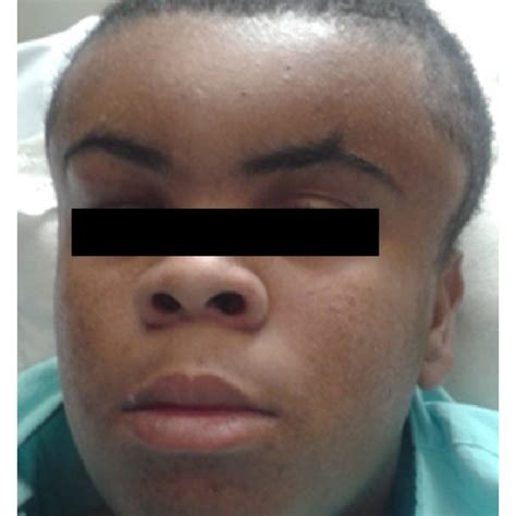 Preoperative Image Of The Patient Showing Extensive Forehead Swelling