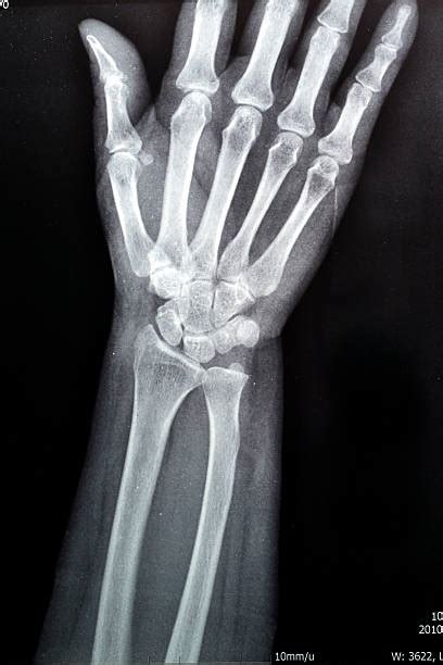 Best Wrist Xray Stock Photos Pictures And Royalty Free Images Istock