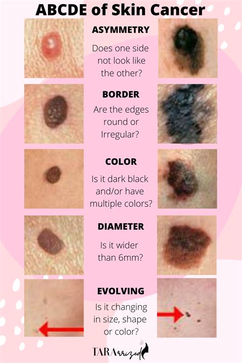 ABCDE S Of Skin Cancer What You Need To Know Tararrized