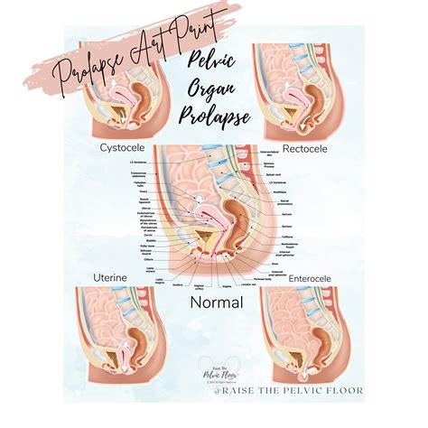 Prolapse Bladder Rectum Uterus Intestine Art Print Cystocele