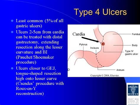 Gastric Ulcer Classification