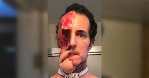 Man Loses Half Of His Face To Cancer But Inspires Others