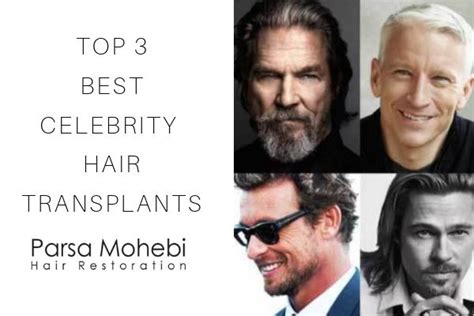 Top Best Celebrity Hair Transplants