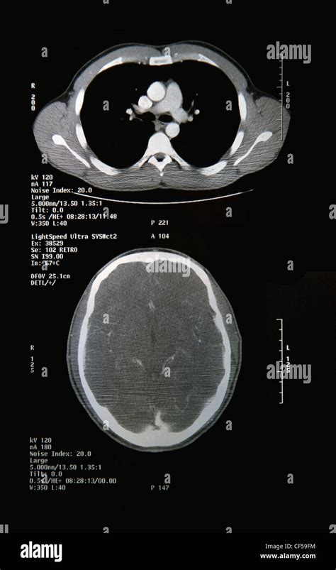 Head And Neck Ct Scan