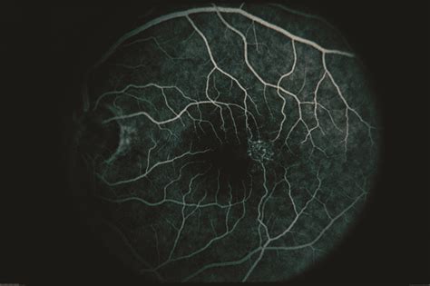 Idiopathic Juxtafoveal Telangiectasis Retina Specialists Of North