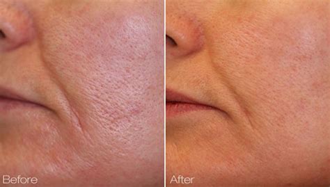 Facial Pore Reduction Pore Tightening In Denver Centennial Colorado