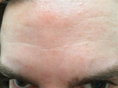 Skin Concerns Itchy Inflamed Bumps And Patches On Forehead Skincareaddiction